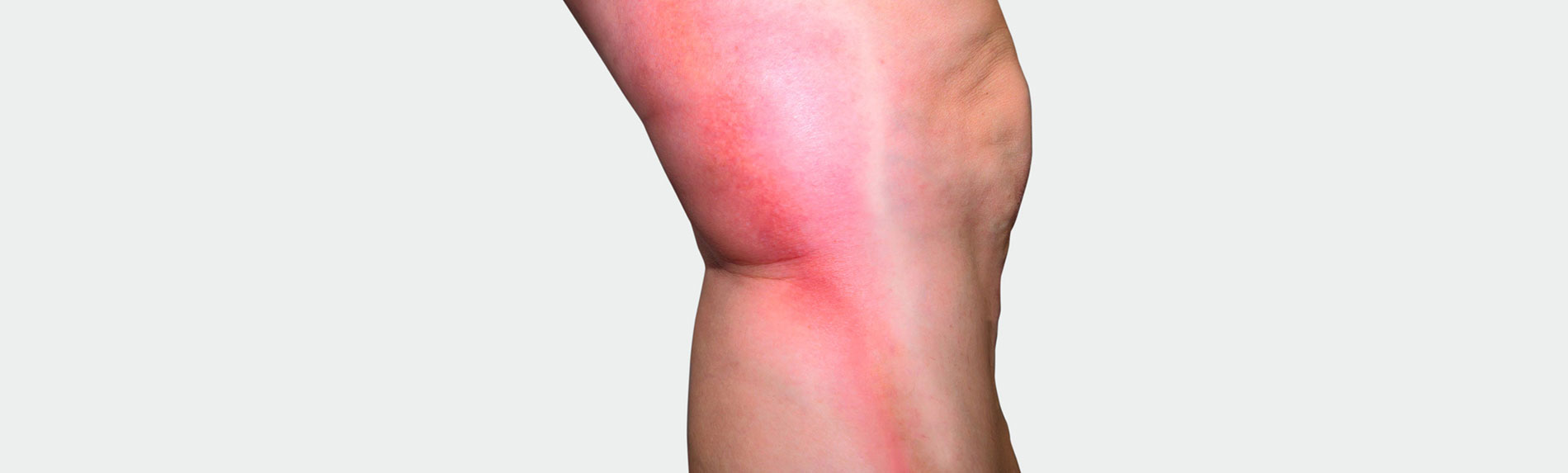 Trombose Perna com sintomas de trombose