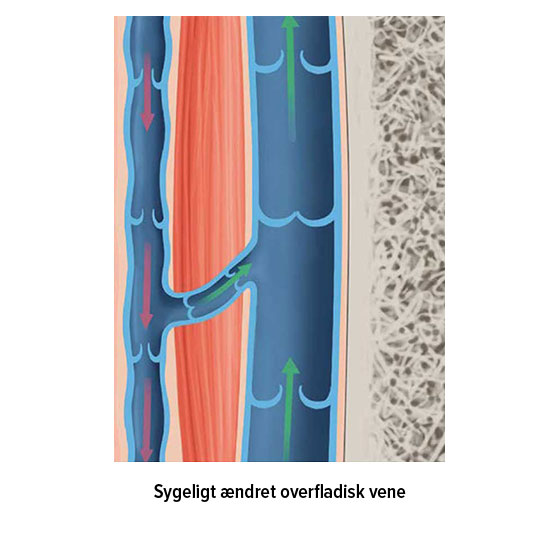 Sygeligt ændret overfladisk vene Sygeligt ændret overfladisk vene