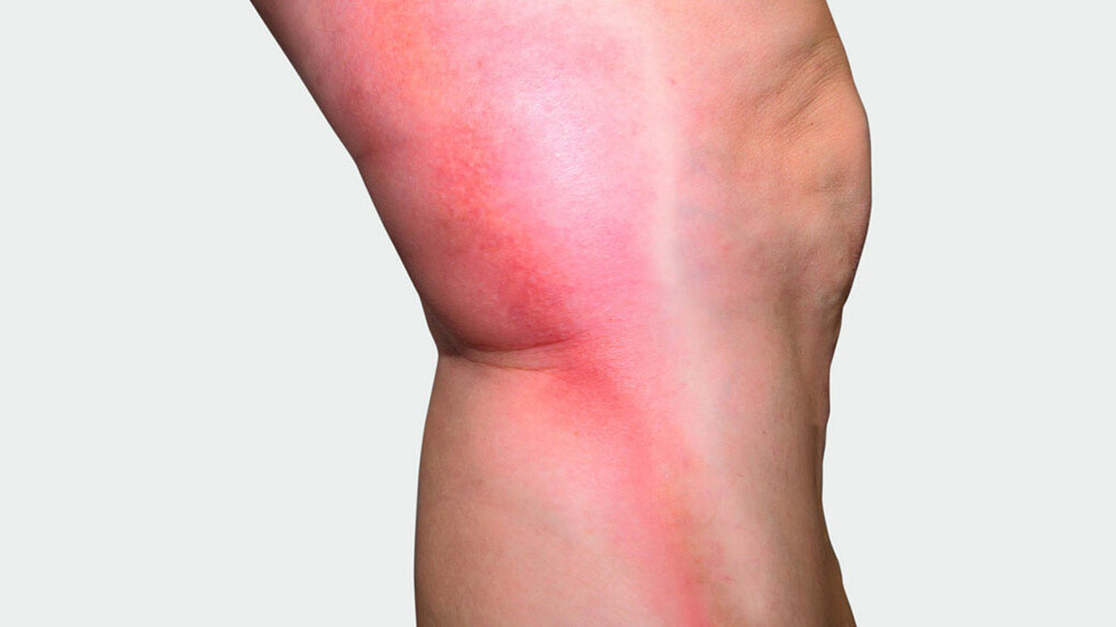 Mainteaser Thrombose Beine mit rotem Strang auf der Seite