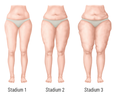 Indelning av stadier för morfologisk särskiljning