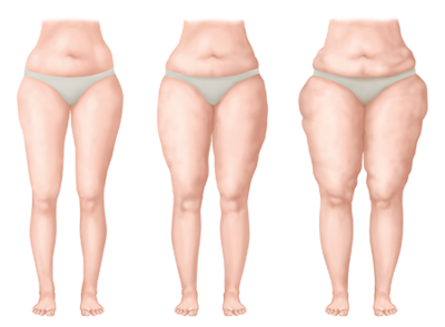 Diagram showing the stages of lipoedema