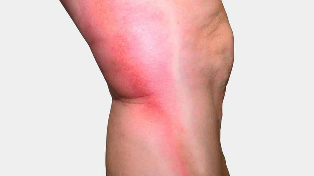 Beine mit rotem Strang auf der Seite