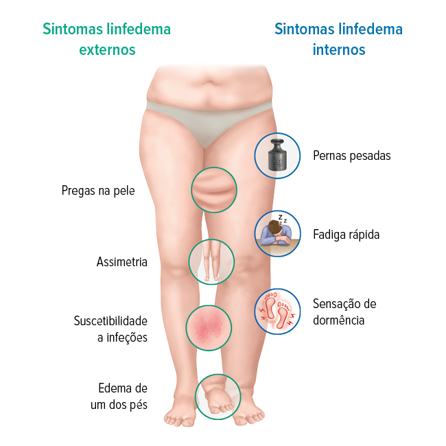 Os sintomas de linfedema Os sintomas de linfedema