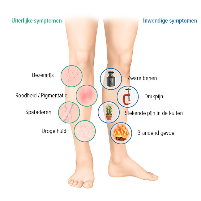 Symptomen van veneuze aandoeningen