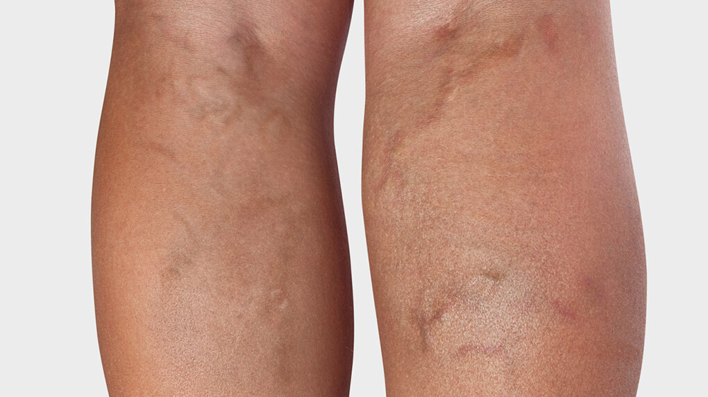 Spataderen Spataderen