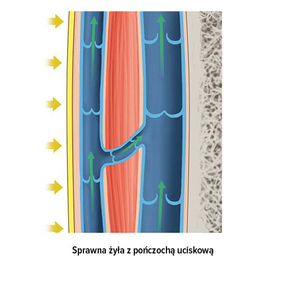 Sprawna żyła z pończochą uciskową Sprawna żyła z pończochą uciskową