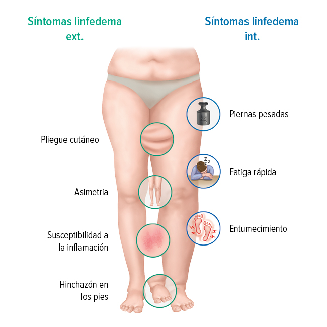 Los síntomas de un linfedema Los síntomas de un linfedema