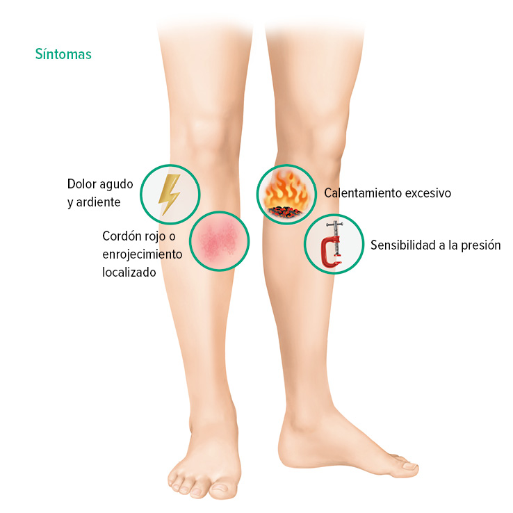 Síntomas de la trombosis venosa superficial Síntomas de la trombosis venosa superficial