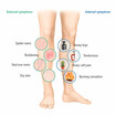 Symptoms of venous disorders