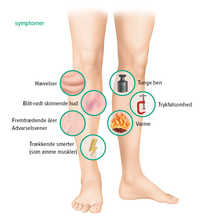 Symptomer på dyb venetrombose Symptomer på dyb venetrombose