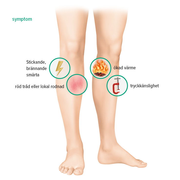 Symptom ytlig (superficiell) ventrombos Symptom ytlig (superficiell) ventrombos