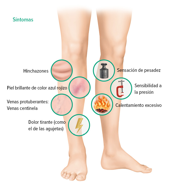 Síntomas de la trombosis venosa profunda Síntomas de la trombosis venosa profunda