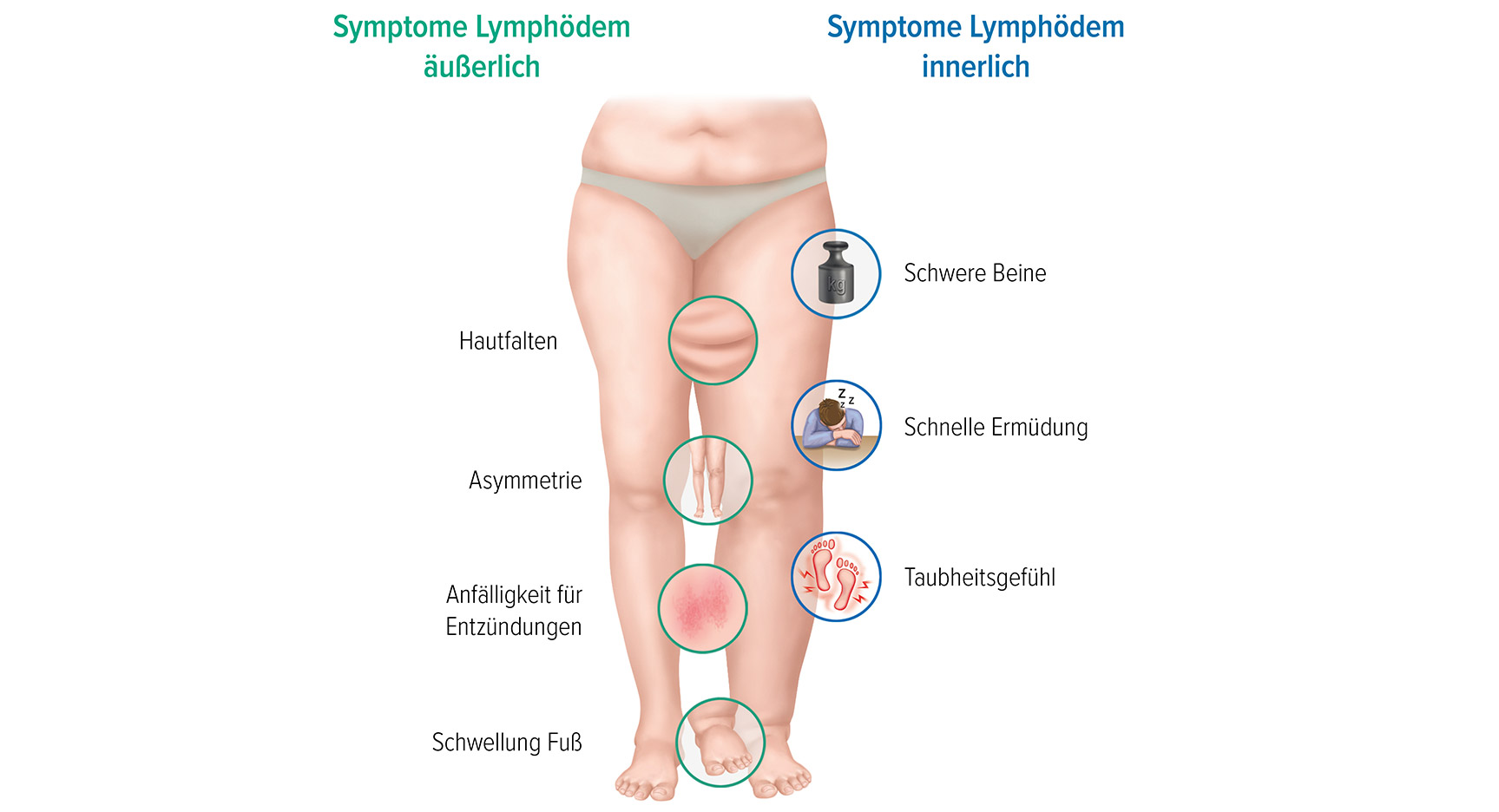 Die Symptome für ein Lymphödem Die Symptome für ein Lymphödem