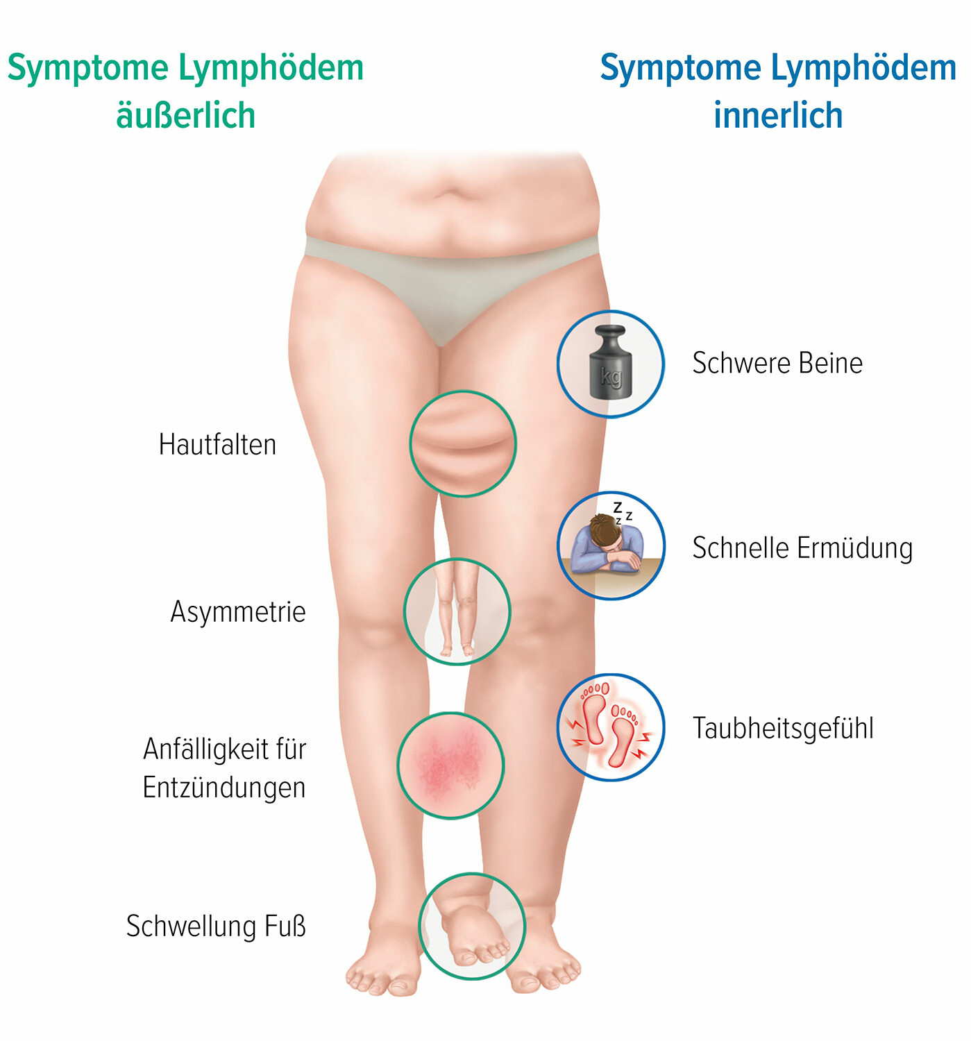 Die Symptome für ein Lymphödem Die Symptome für ein Lymphödem