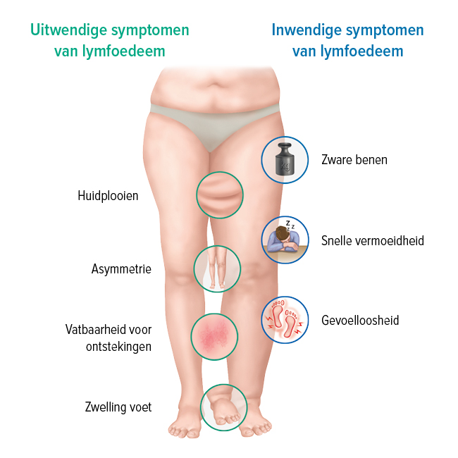 De symptomen van een lymfoedeem De symptomen van een lymfoedeem