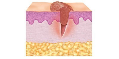Abbildung Hautschichten in Granulationsphase