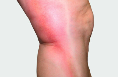 Ny vidensside om trombose