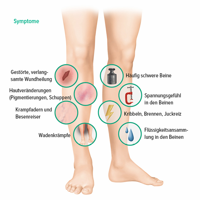 Symptome einer CVI Symptome einer CVI