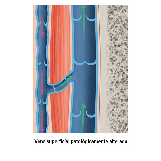 Vena superficial patológicamente alterada