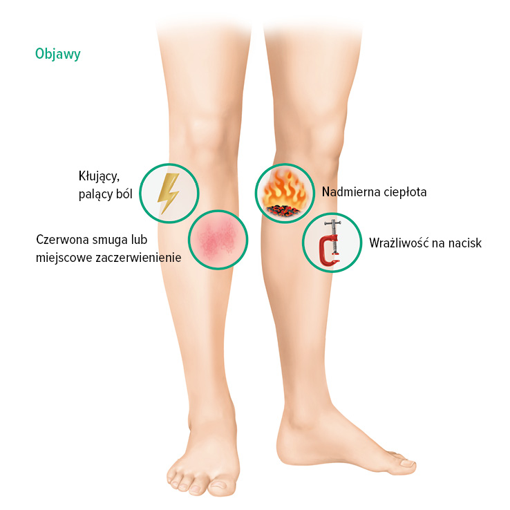 Objawy zakrzepicy żył powierzchownych Objawy zakrzepicy żył powierzchownych
