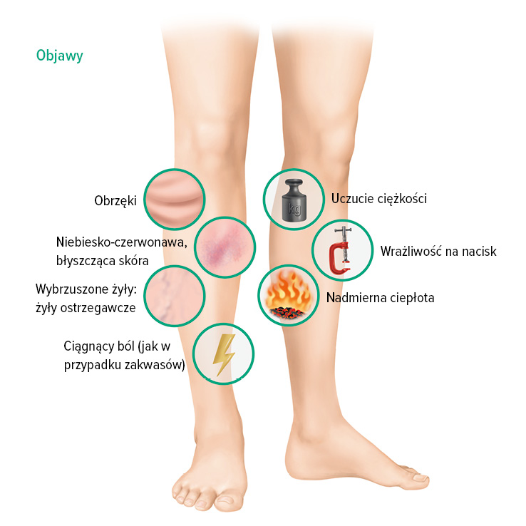 Objawy zakrzepicy żył głębokich Objawy zakrzepicy żył głębokich