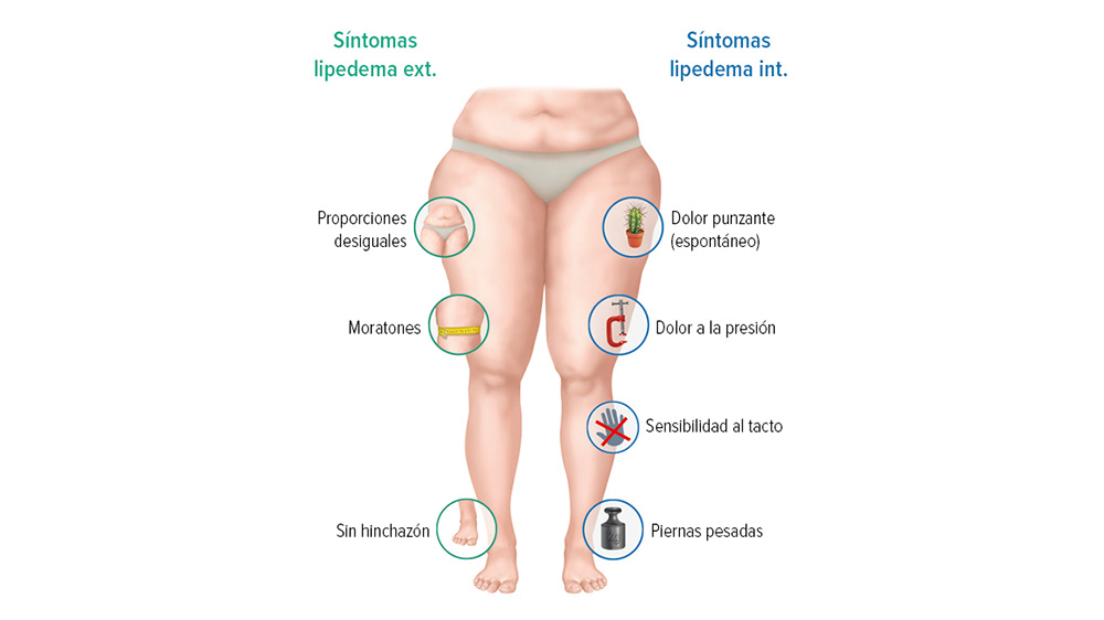 Gráfico de síntomas del lipedema