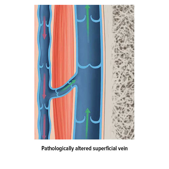 Pathologically altered superficial vein