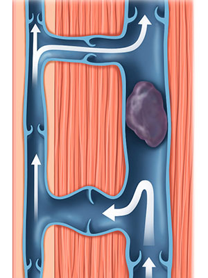 tiefe Beinvenenthrombose tiefe Beinvenenthrombose