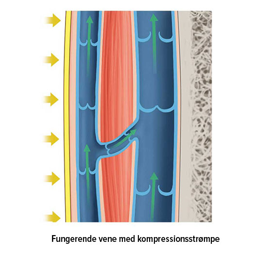 Fungerende vene med kompressionsstrømpe Fungerende vene med kompressionsstrømpe