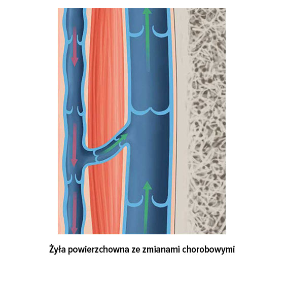 Żyła powierzchowna ze zmianami chorobowymi Żyła powierzchowna ze zmianami chorobowymi