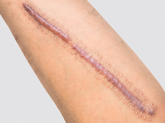 Cicatrizes hipertróficas