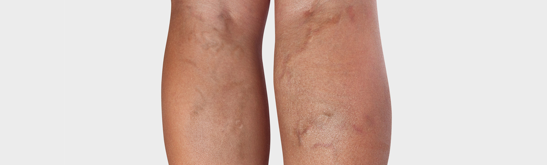 Beine mit Krampfadern