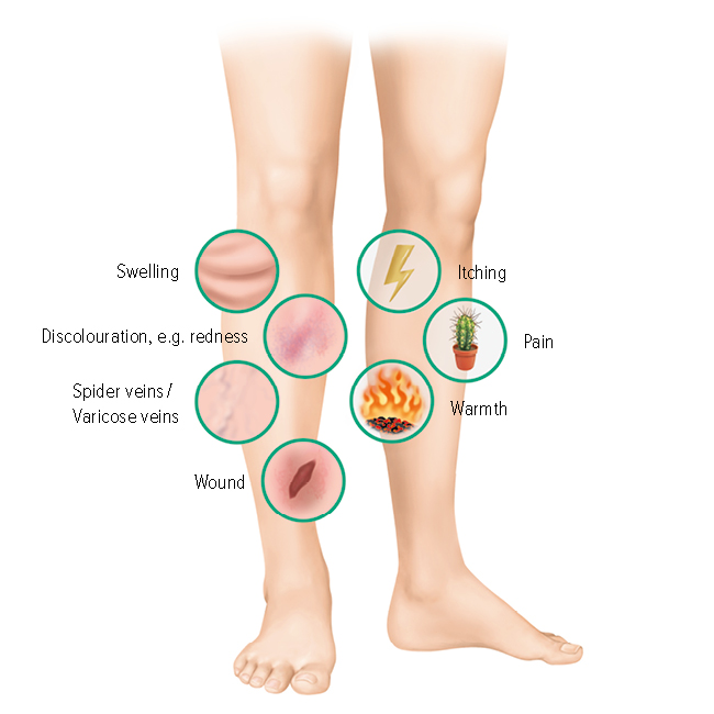Symptoms of venous leg ulcers Symptoms of venous leg ulcers