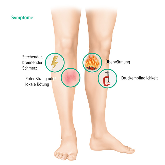 Symptome oberflächliche Venenthrombose