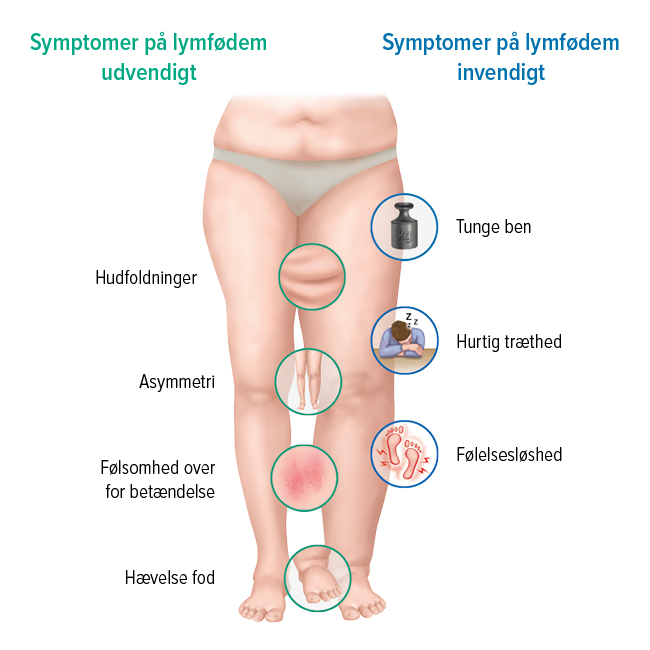 Symptomerne på et lymfødem