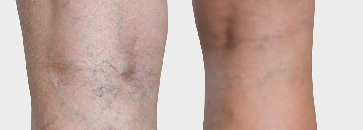 Varicosités Varicosités