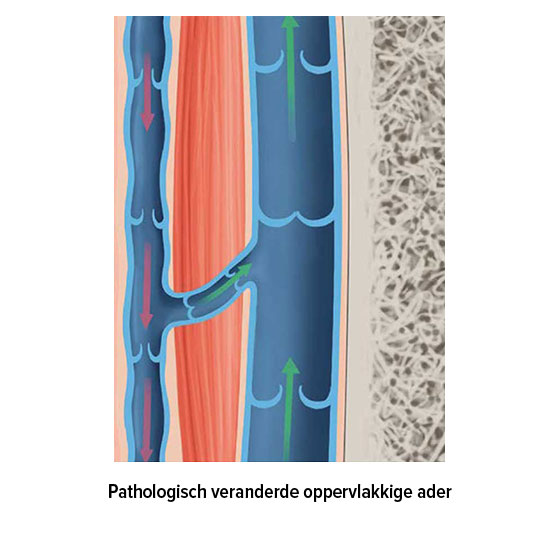 Pathologisch veranderde oppervlakkige ader Pathologisch veranderde oppervlakkige ader