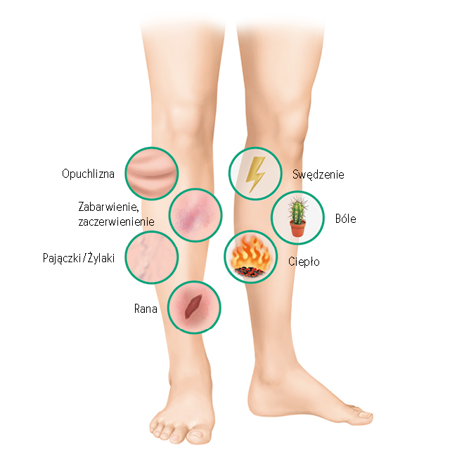 Objawy owrzodzenia żylnego podudzi Objawy owrzodzenia żylnego podudzi