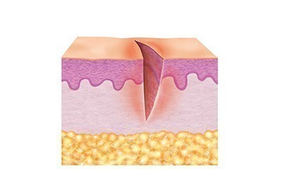 1. Hudens inflammationsfas (rengöringsfas)
