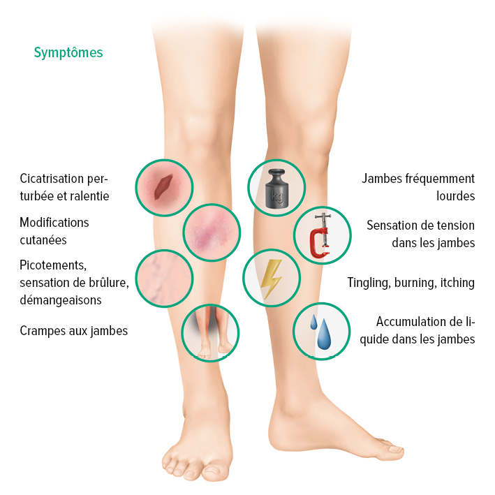 Symptômes d'une IVC Symptômes d'une IVC
